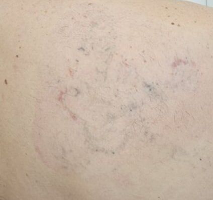 Tattoo Removal - After