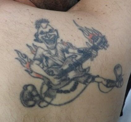 Tattoo Removal - Before