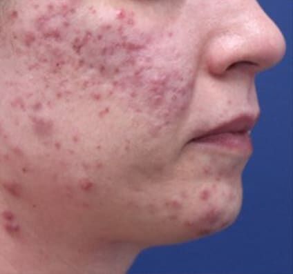 Acne & Acne Scars - Before