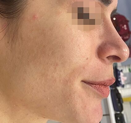 Active Acne Treatment - After