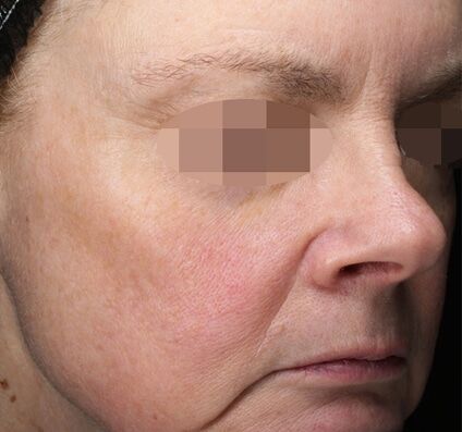 Pigmentation & Sun Damage - After