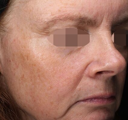 Pigmentation & Sun Damage - Before