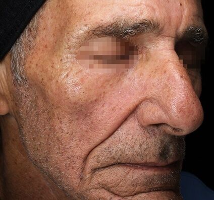 Skin Texture & Tone - After